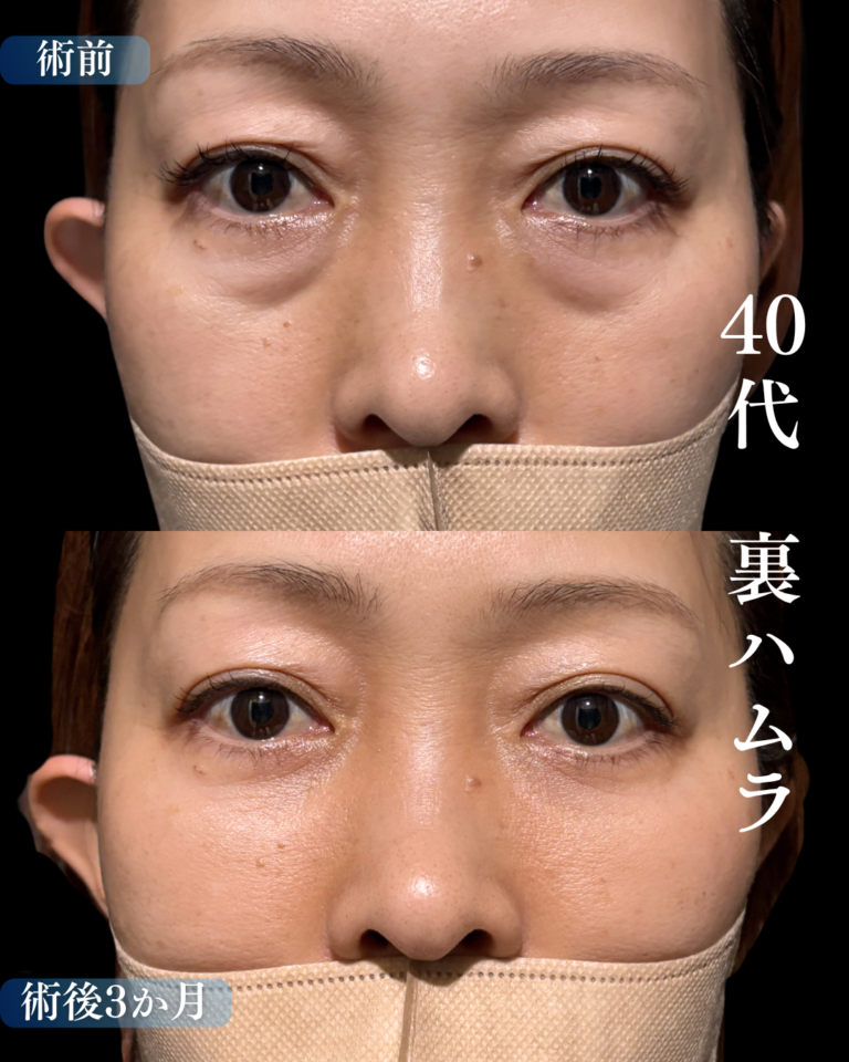 40代女性　裏ハムラ法